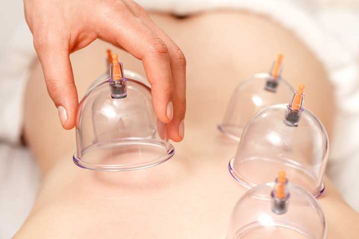Cupping_319840018